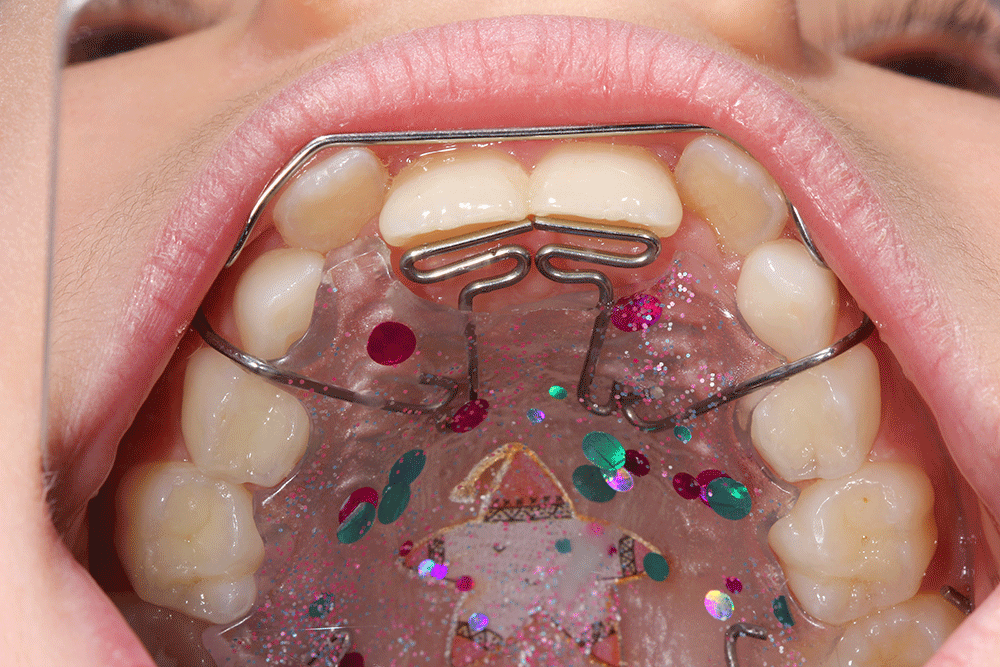 Пластина на зубы для детей фото