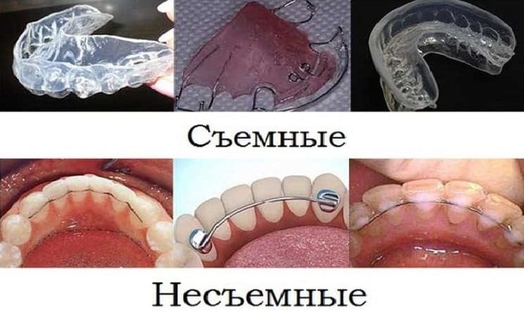 Ретейнеры что это в стоматологии и зачем они нужны